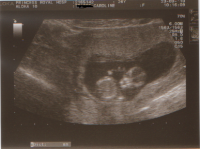 Ultrasounds 12 wks 3.png