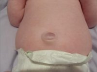 umbilical hernia.JPG