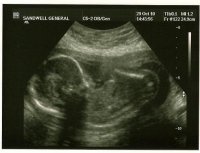 20wks scan 1.JPG
