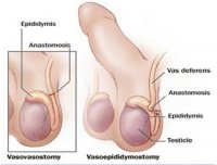 vasectomy-reversal-surgery-india_clip_image002.jpg