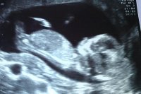 nuchal scan.jpg