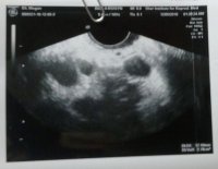 ovary.jpg