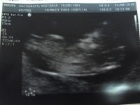 11+5 NT scan(24-08-10).jpg