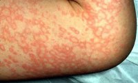 5th_disease_08.jpg