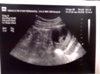 9weeks 5days kicking away.jpg