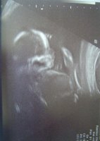 20 week scan (20 + 1) 002.jpg