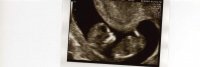 baby nuchal scan.jpg