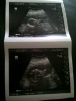 amomaly scan.jpg