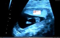 US 13 weeks girl shot.jpg