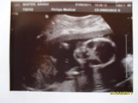 My 20 week scan Ashton Louis.jpg