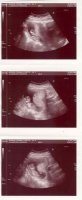 Lynnettes first baby scan.jpg