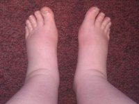 swollen feet_sm.jpg