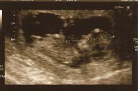 baby again with chin on chest 11 weeks 5 days.jpg