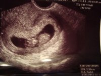 9+6 ultrasound (2).jpg