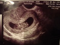 9+6 ultrasound.jpg