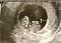 baby A 11wk foot.jpg