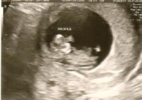 baby A 11wk profile.jpg