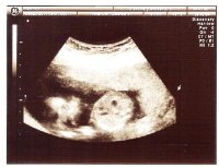15w2dSonogram.jpg