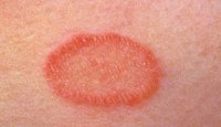 M240164-Pityriais_rosea__close-up_of_a_single_lesion-SPL.jpg