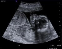 18 Weeks, Profile.jpg