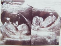 TWINS 12 weeks (2).jpg