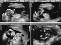 ultrasound16w5d_ALLsmall.jpg