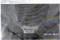 my pelvis plyus metal12.jpg