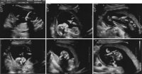 ultrasound17w6d_allsmall.jpg