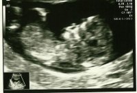 Ultrasound.jpg