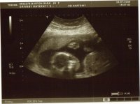 20 week scan xxx.jpg