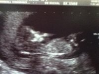 Ultrasound 12 weeks.jpg