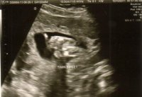 baby B 22 wks feet.jpg