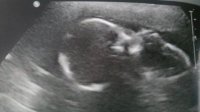 ultrasound20w2d.jpg