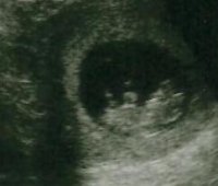 10weeks+5days Ultrasound 002.jpg