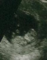 10weeks+5days Ultrasound 003.jpg
