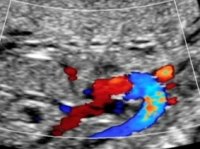 20 week scan heart.jpg