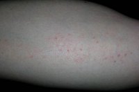 petechiae.jpg