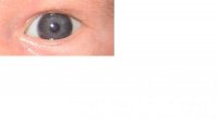 Eye colour birth.jpg