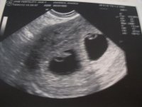 baby a and baby b.jpg