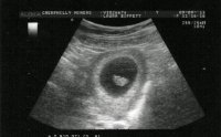 bean 8 week scan.jpg