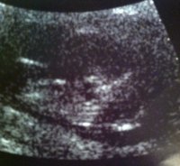 12 week 1 day NT scan.jpg