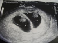baby a baby b 8 weeks 6 days.jpg