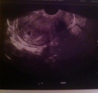 Ultrasound 5 weeks (cropped).jpg