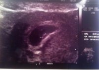 Ultrasound 6w2d.jpg