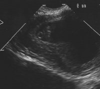 Ultrasound 3:6 (8w0d).jpg