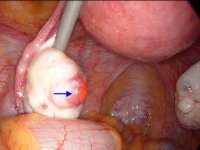 jgeorgemd_right-tube-ovary2sm.jpg