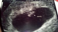 6 weeks 6 days measuring 6 weeks 2 days.jpg