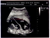 Twins Ultrasound 1.jpg
