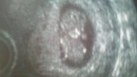 10 weeks_166bpm_30.8 mm.jpg