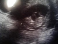 11 week 6 day ultrasound.jpg
